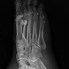 Image result for OS Peroneum X-ray