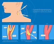 Image result for Carotid Endarterectomy Surgery