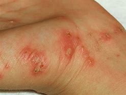 Image result for Scabies Skin Disease