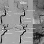 Image result for Internal Carotid Artery Branches