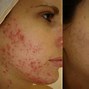 Image result for Severely Textured Skin