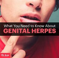 Image result for Female Wart Genital Herpes