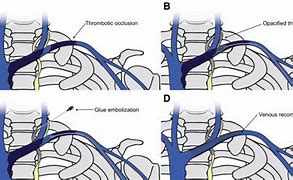 Image result for Thoracic Duct Embolization
