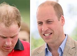 Image result for Prince Harry Thinning Hair