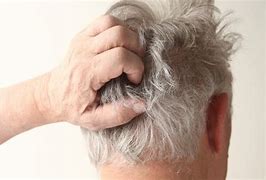 Image result for Scabies in Hair and Scalp