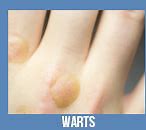 Image result for Venereal Warts