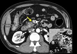 Image result for Pancreas Tumor MRI