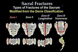 Image result for Sacrum Coccyx Fracture