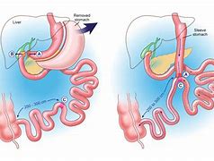 Image result for duodenal