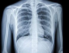 Image result for Lung Tumor Size Chart X-ray