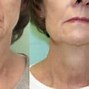 Image result for Radiofrequency Treatment