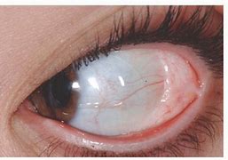 Image result for Conjunctival Mass