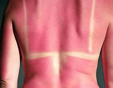 Image result for SunBurn Back