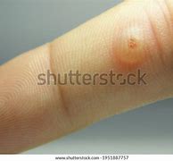 Image result for Blister After Cryotherapy
