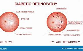 Image result for Retinopathy Symptoms