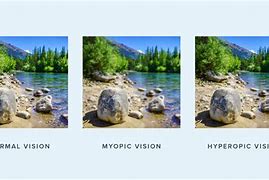 Image result for Astigmatism vs Myopia