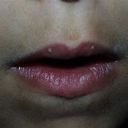Image result for Warts in Mouth