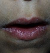 Image result for Wart On Lip