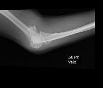 Image result for Broke My Arm