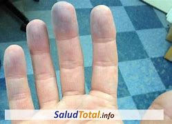 Image result for cianosis