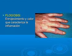 Image result for flogosis
