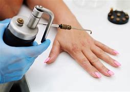 Image result for Wart Removal Tool