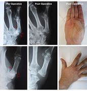 Image result for Thumb CMC Joint Arthritis