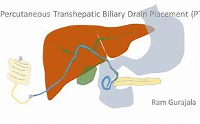 Image result for PTC Biliary Drain
