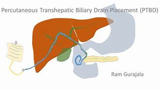 Image result for Biliary Drain Dressing