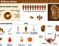 Image result for How Big Is 7 mm Kidney Stone