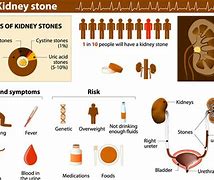 Image result for Kidney Stone Actual Size