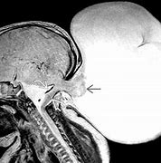 Image result for Encephalocele and Chiari Malformation