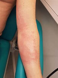 Image result for Allergic Reaction Arm