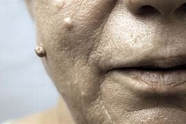 Image result for Skin Warts On Face