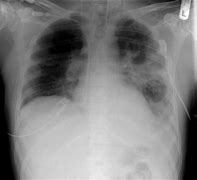 Image result for Right Lower Lobe Pneumonia Chest X-Ray