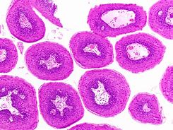 Image result for Papilloma Cytology