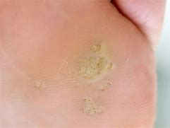 Image result for Calluses On Bottom of Feet