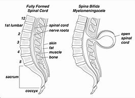 Image result for Spina Bifida Meningocele