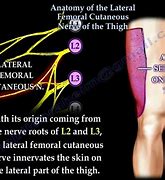 Image result for Femoral Nerve Entrapment