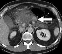 Image result for Pancreatitis CT Findings