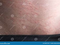 Image result for Venereal Disease Pictures in Male