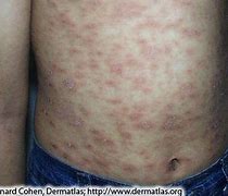 Image result for Rash Covering Entire Body
