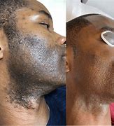 Image result for Ingrown Hair On Face