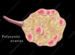 Image result for Polycystic Ovary Morphology