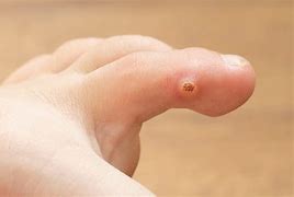 Image result for Foot Warts