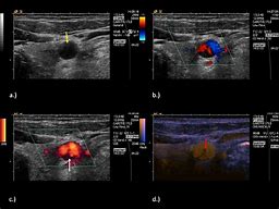 Image result for Carotid Dissection Ultrasound Images