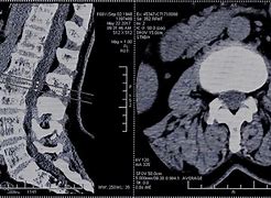 Image result for Healthy Lumbar Spine CT Scan