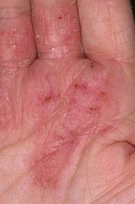 Image result for Rash From Nickel Allergy