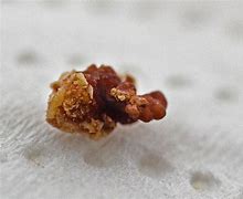 Image result for Kidney Stone 7Mm in Size Picture