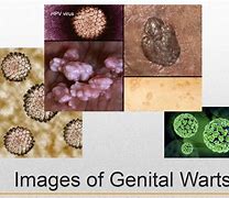 Image result for STDs That Cause Warts